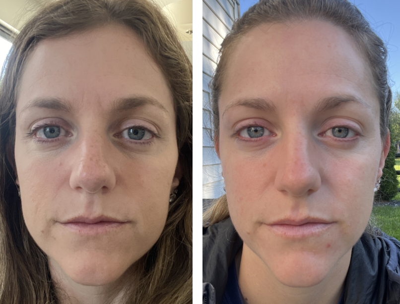 Kelsey’s Nuvane results: before on the left, after on the right
