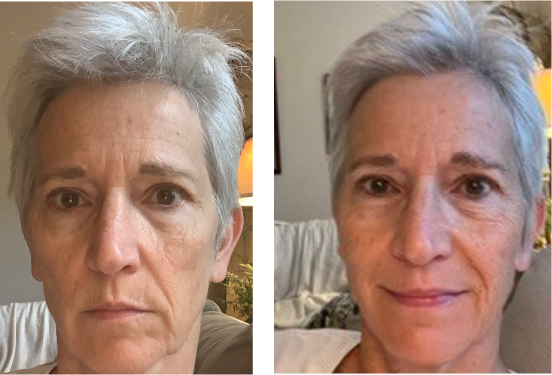 Theresa’s Nuvane results: before on the left, after on the right